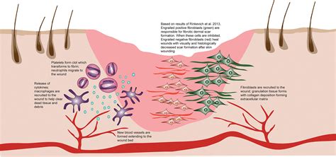 Wound Healing And Fibrosis Current Stem Cell Therapies Jones