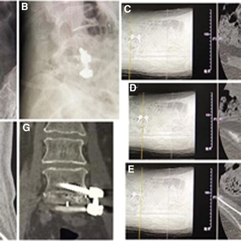 A Posteroanterior And B Lateral X Ray Image And C E Axial Ct