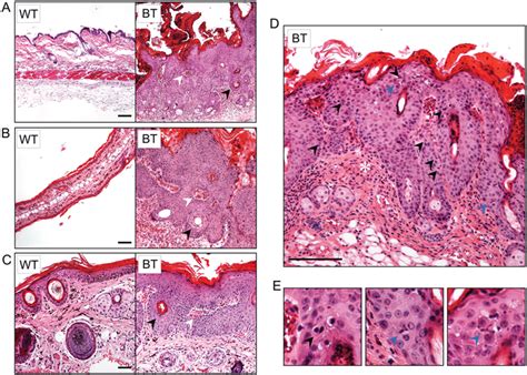 Ets1 Expression Causes Hyperplastic And Dysplastic Changes In The Skin