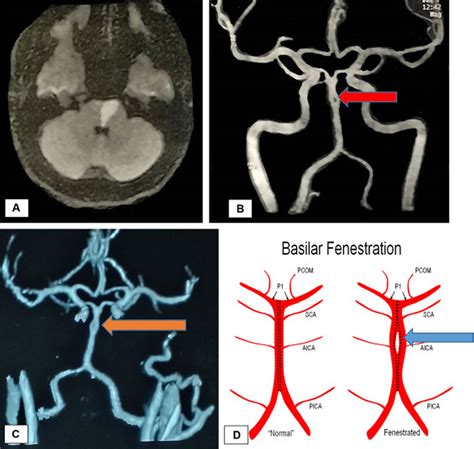 Basilar artery anatomy, aneurysm, thrombosis, hypoplasia, dolichoectasia & basilar syndrome