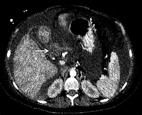 Computed Tomography An Optimal Modality For The Detection Of