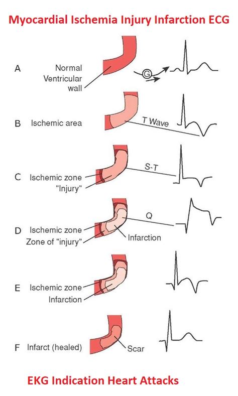 ECG Indications of Myocardial Ischemia, Injury & Infarction - NCLEX Quiz