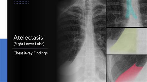 Atelectasis Chest X Ray