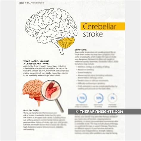 What is a Cerebellar Stroke? in 2021 | Caregiver education, Stroke therapy, Caregiver