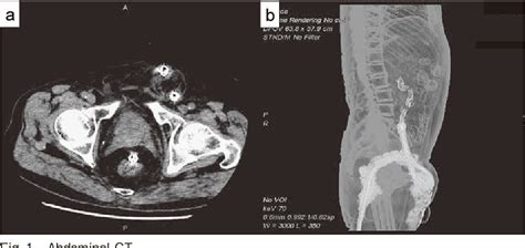 Figure 1 From A Case Of Left Inguinal Hernia With Endoscopic