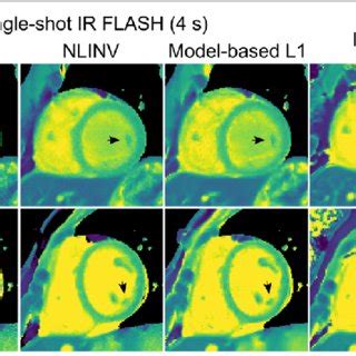 Myocardial T1 Maps Obtained By Single Shot IR Radial Fast Low Angle