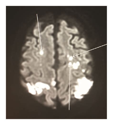 Brain Mri Showing Multiple Septic Emboli Download Scientific Diagram