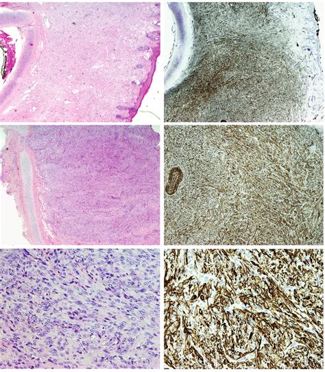 Figure Aggressive Fibromatosis Hemalaun Eosin He Stain Section A B Download Scientific