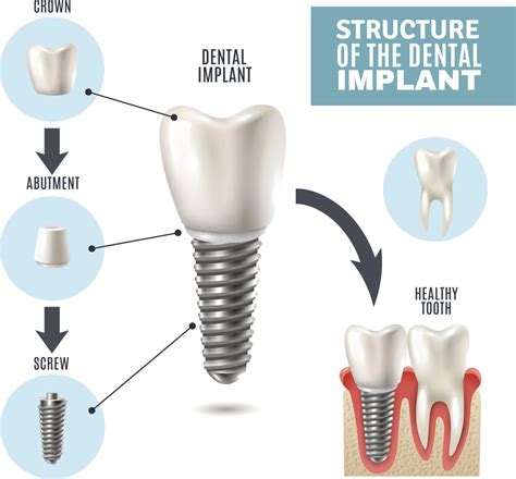 What Are The Benefits Of Dental Implants Replace Missing Teeth