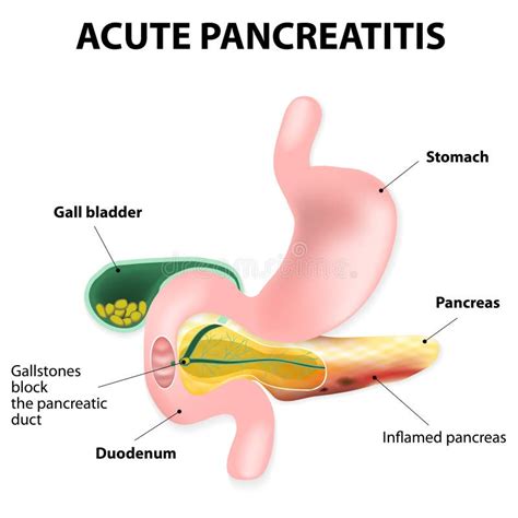 Acute Pancreatitis Stock Vector Illustration Of Block