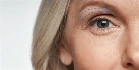 Eyelid Surgery In Wichita Kansas Ks