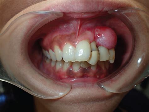 Peripheral Giant Cell Granuloma Vs Pyogenic Granuloma