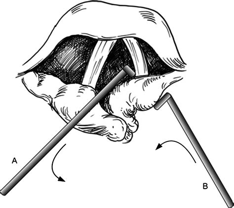 A Promising New Technique For Closed Reduction Of Arytenoid Dislocation The Journal Of