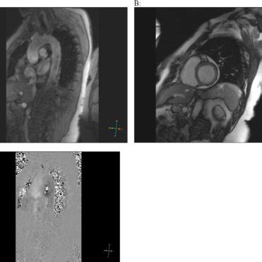 magnetic resonance imaging mri ascending  thoracic aorta