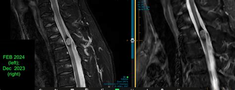 Thoracic Spinal Cord Cavernous Malformation Symptomatic C N S