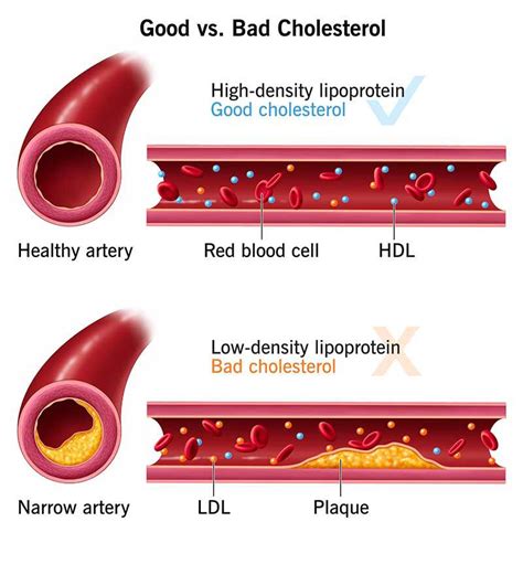 Rising Cholesterol Among Young Population