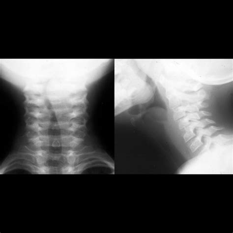 Pediatric Aryepiglottic Fold Cyst | Pediatric Radiology Reference ...