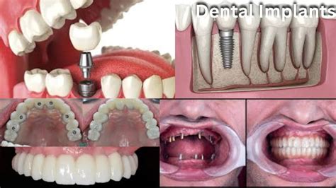 What are the types of dental treatment? - 5Best In City