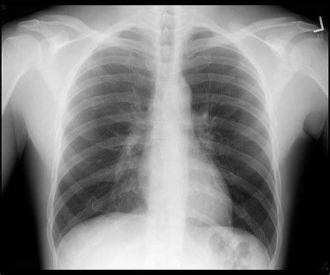 The chest x-ray in cardiovascular disease - wikidoc