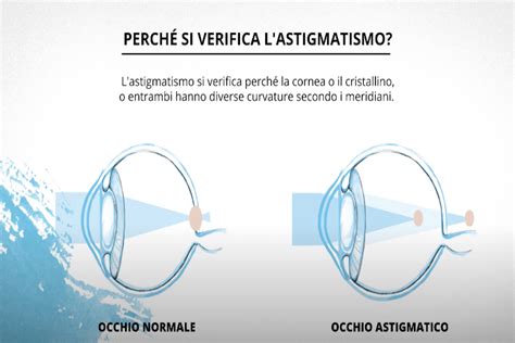 Astigmatismo Che Cos E Come Pu Essere Corretto The Eye News