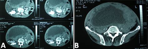 Contrast Ct Abdomen Axial Section Displays Large Well Defined