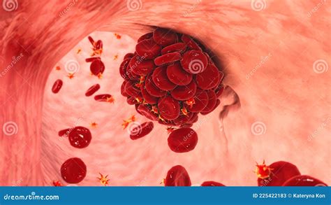 Blood Clot In Damaged Blood Vessel Made Of Red Blood Cells Platelets