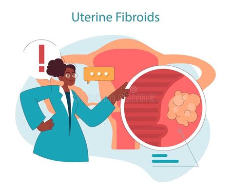 Set Of Uterine Fibroids Female Leiomyomas Reproductive System Uterus