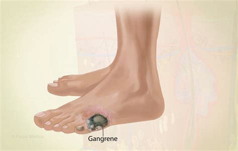 Gangrene Causes Signs And Symptoms Diagnosis And 51 Off