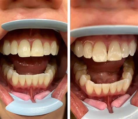 Denture Before And After Dentaluxe