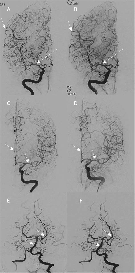 Conventional Cerebral Angiogram Ap View Of The Bilateral Internal