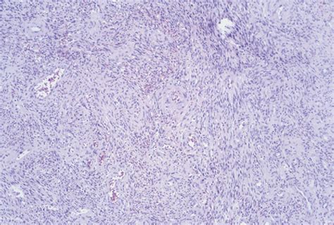 Primary Intraosseous Kaposis Sarcoma Presenting As An Asymptomatic