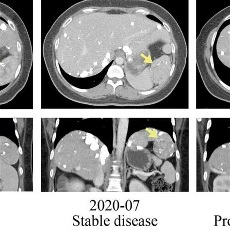 Computerized Tomography Scan Before And After Treatment Download Scientific Diagram