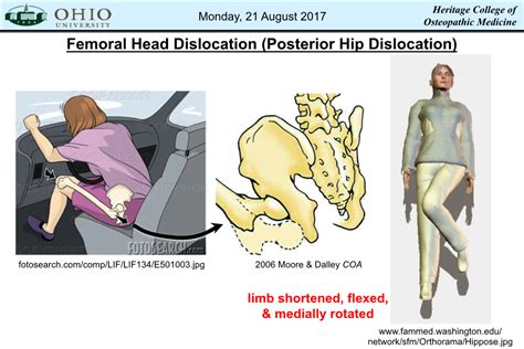 Femoral Head Dislocation Posterior Hip Dislocation Docslib