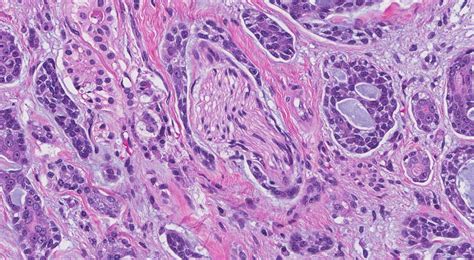 Adenoid cystic carcinoma | Ottawa Atlas of Pathology