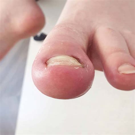 Ingrown Toenails The London Podiatrist