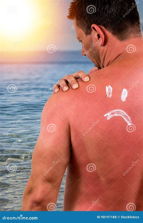 Sunburned Skin On Shoulder And Back Of A Woman Red Skin Sun Burn After