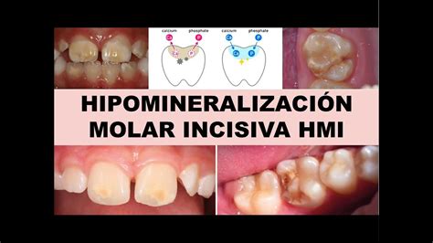 Hipomineralizaci N Molar Incisiva Hmi Youtube