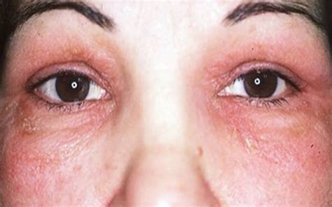 Alergias oculares conjuntivitis y reacción alérgica EMGIDI