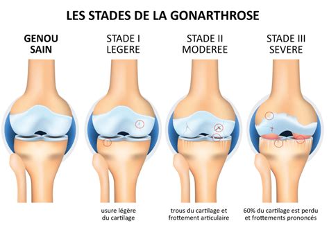 Gonarthrose Douleur Au Genou Enovis France