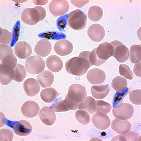 Plasmodium Falciparum Microbiology Laboratory Turkey - Riset