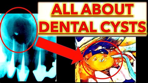 MASTERING Odontogenic Cysts TUTORIAL OKC Radicular Dentigerous