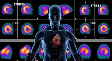 Nuclear Stress Test Prep Precautions After Side Effects