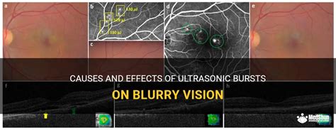 Causes And Effects Of Ultrasonic Bursts On Blurry Vision Medshun