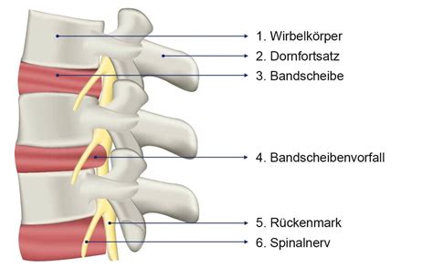 Ursachen Symptome Bandscheibenvorfall Rückenschmerzen