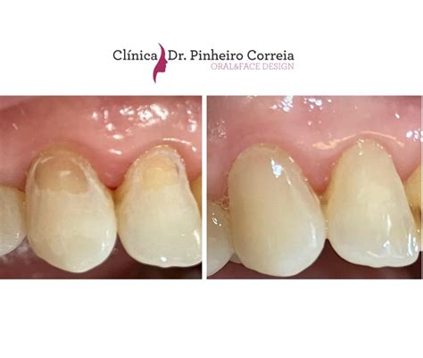 dentisteria estetica Clínica Dr Pinheiro Correia