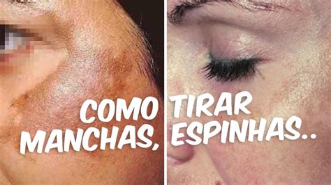 Como Remover Melasma Do Rosto Youtube