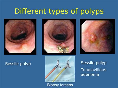 PPT Overview Of Colorectal Cancer PowerPoint Presentation Free