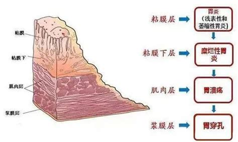 糜烂性胃炎是胃“烂”了吗？ 本文带你揭开胃糜烂的真相凤凰网