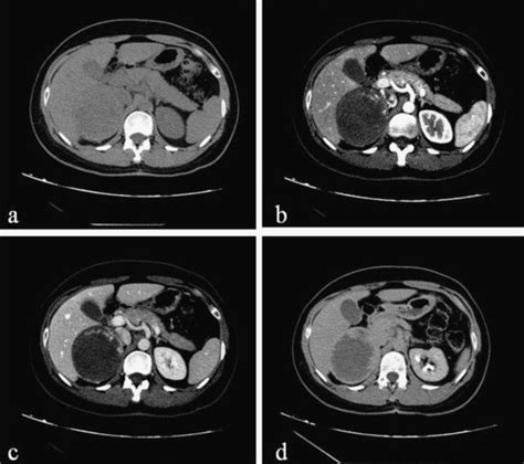 (a) noncontrast-enhanced CT scan showing encapsulate large right ...