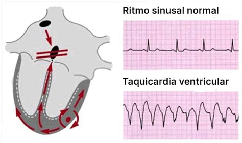 Capítulo 8 Fibrilación ventricular y TV sin pulso